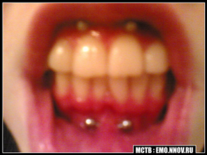 хочу проколоть уздечку и десну