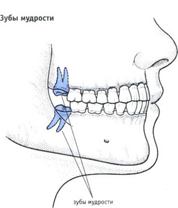 чтобы прорезался зуб мудрости