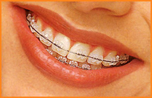 Исправить наконец прикус!!!