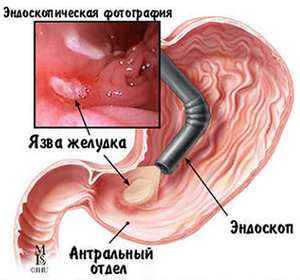 Гастроскопия