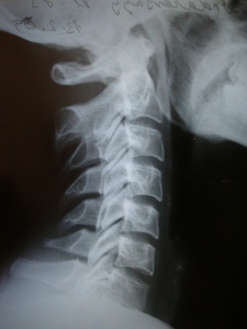 Рентген шейного отдела