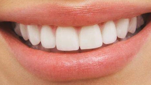 Trattamento sbiancante per denti | Отбеливание зубов
