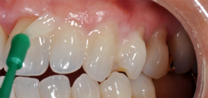Укрепление зубной эмали