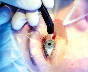 Vision surgery