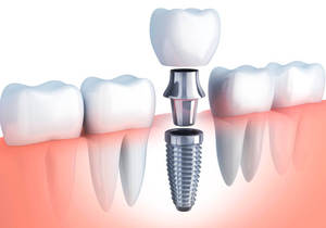 Имплантация зуба