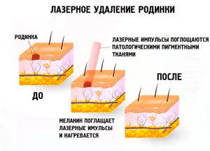 Удалить родинку