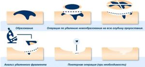 Удалить оставшиеся родинки