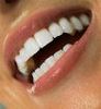 курс отбеливания зубов