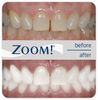 Отбеливание зубов ZOOM 3