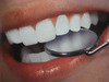 Профессиональная чистка и отбеливание зубов