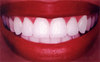идеальные зубы