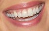 Белые ровные зубы
