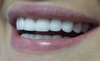 Фарфоровый (оксид циркония) унитаз во рту от стоматолога мецената