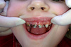 Чем опасен кариес или зачем лечить зубы?