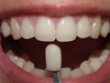 протезирование зубов винирами