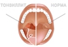 Лечить уже тонзиллит