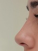 ринопластика носа