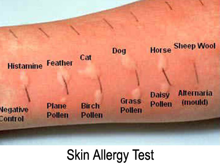 Как сделать тесты на аллергию