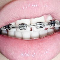 Brackets