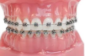 сняяяять брекеты